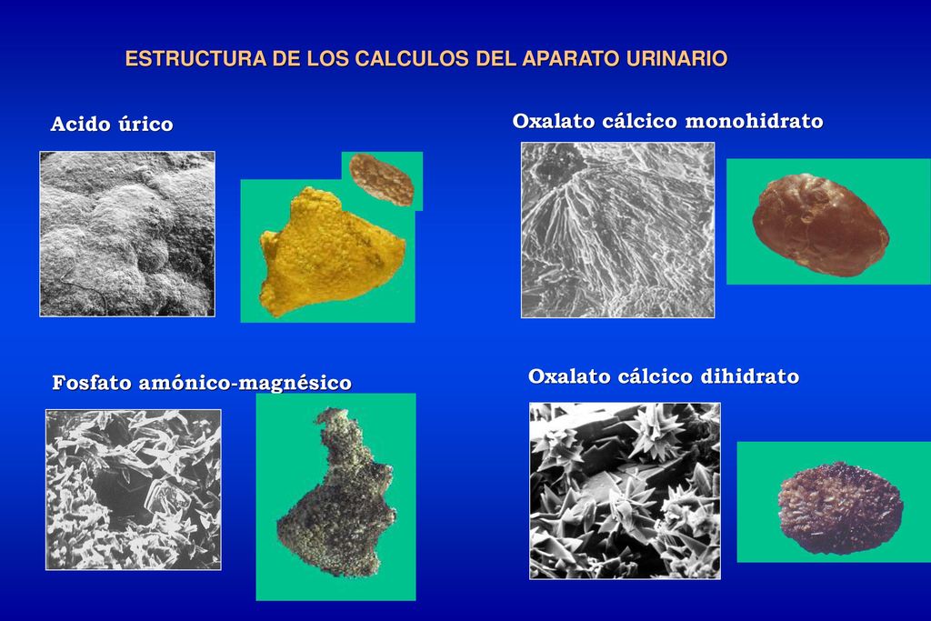 Calculos oxalato calcico dihidrato